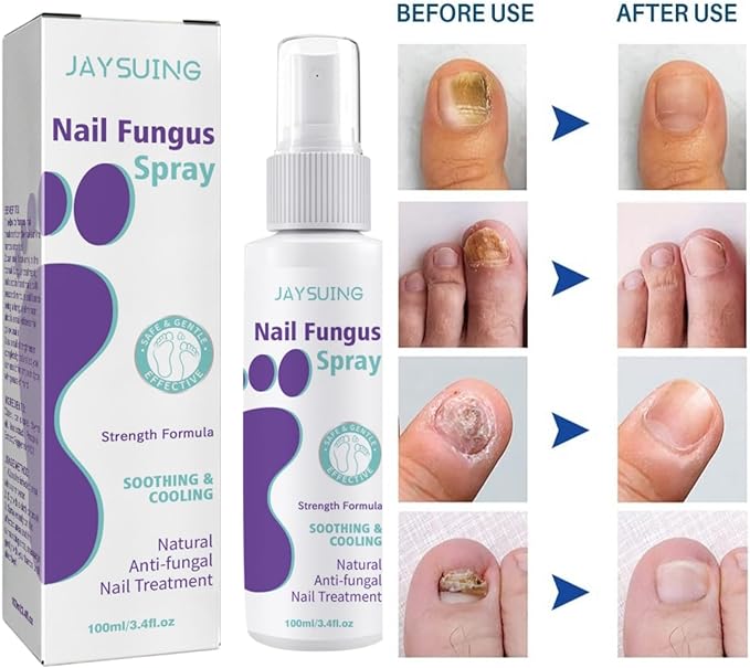 Jaysuing Nail Fungus Spray 100ml