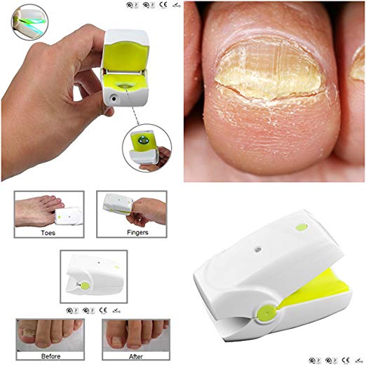 Professional Nail Fungus Laser Device